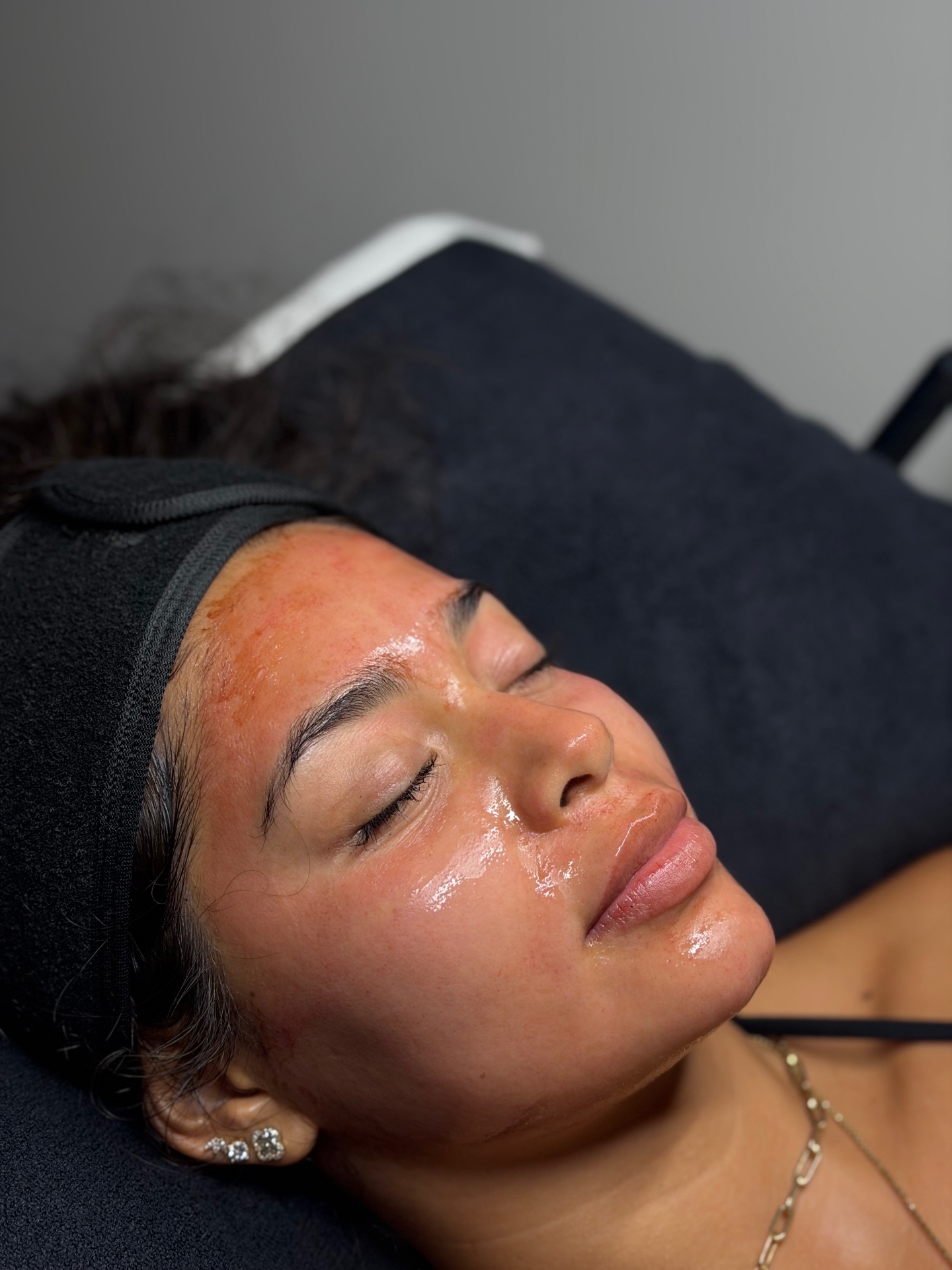 Client's skin glowing after microneedling at Faced.